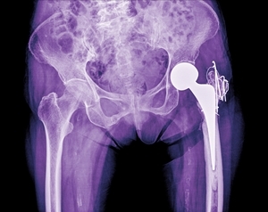 Hip surgery is a common operation that requires extensive physical therapy.